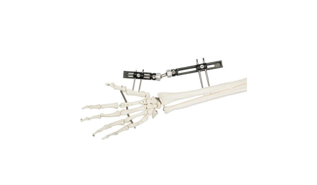 EXTERNAL FIXATORS - Rayat Grup
