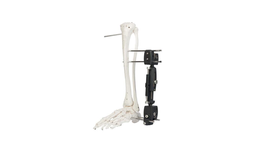 EXTERNAL FIXATORS - Rayat Grup
